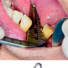 Daily Dental Implant Positioning Guide DDI