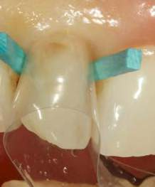 Smart Wedge DDI
