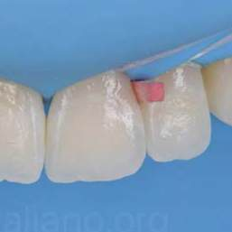 Smart Wedge DDI