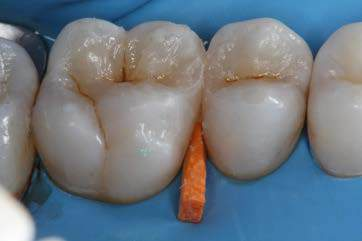 Smart Wedge DDI