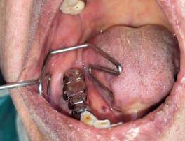 ISO Guard DDI – BUZZDENT
