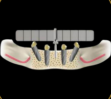 Daily All On implants Guide DDI