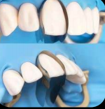 Pro-Veneer Matrix DDi