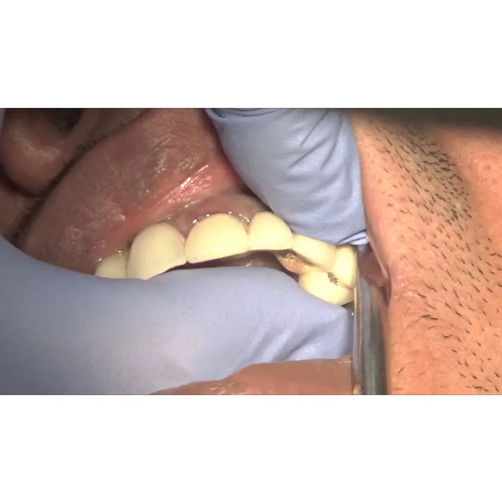 GDC Crown Removel Automatic (CRS)