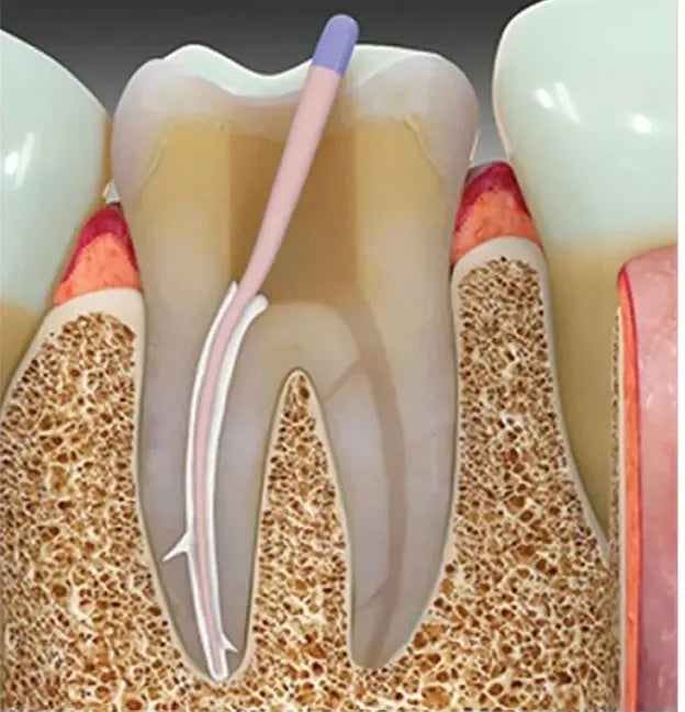Sealpex Root Canal Sealer